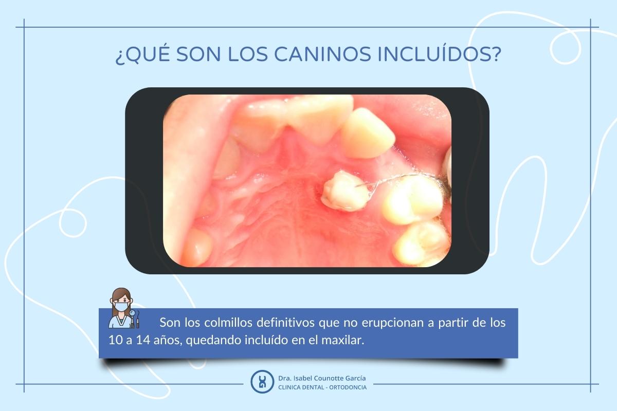 Caninos incluídos Clinica Dental Dra Isabel Counotte