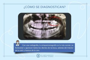 como se diagnostican los caninos incluidos