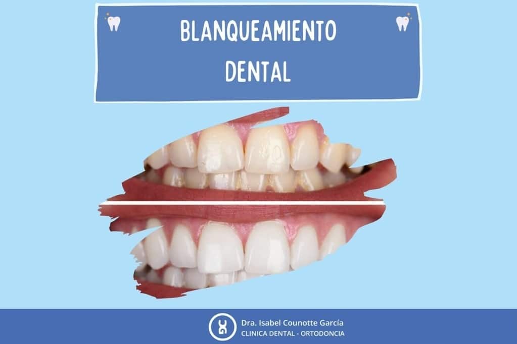 Antes y después del blanqueamiento dental