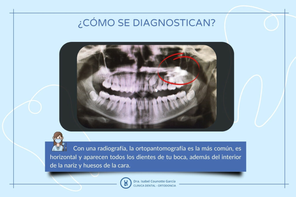 Radiografía dental mostrando diagnóstico ortodóntico.