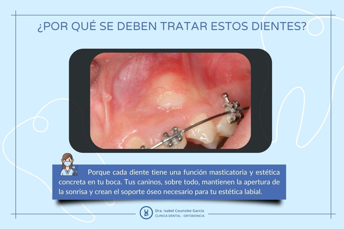 Importancia del tratamiento dental adecuado.