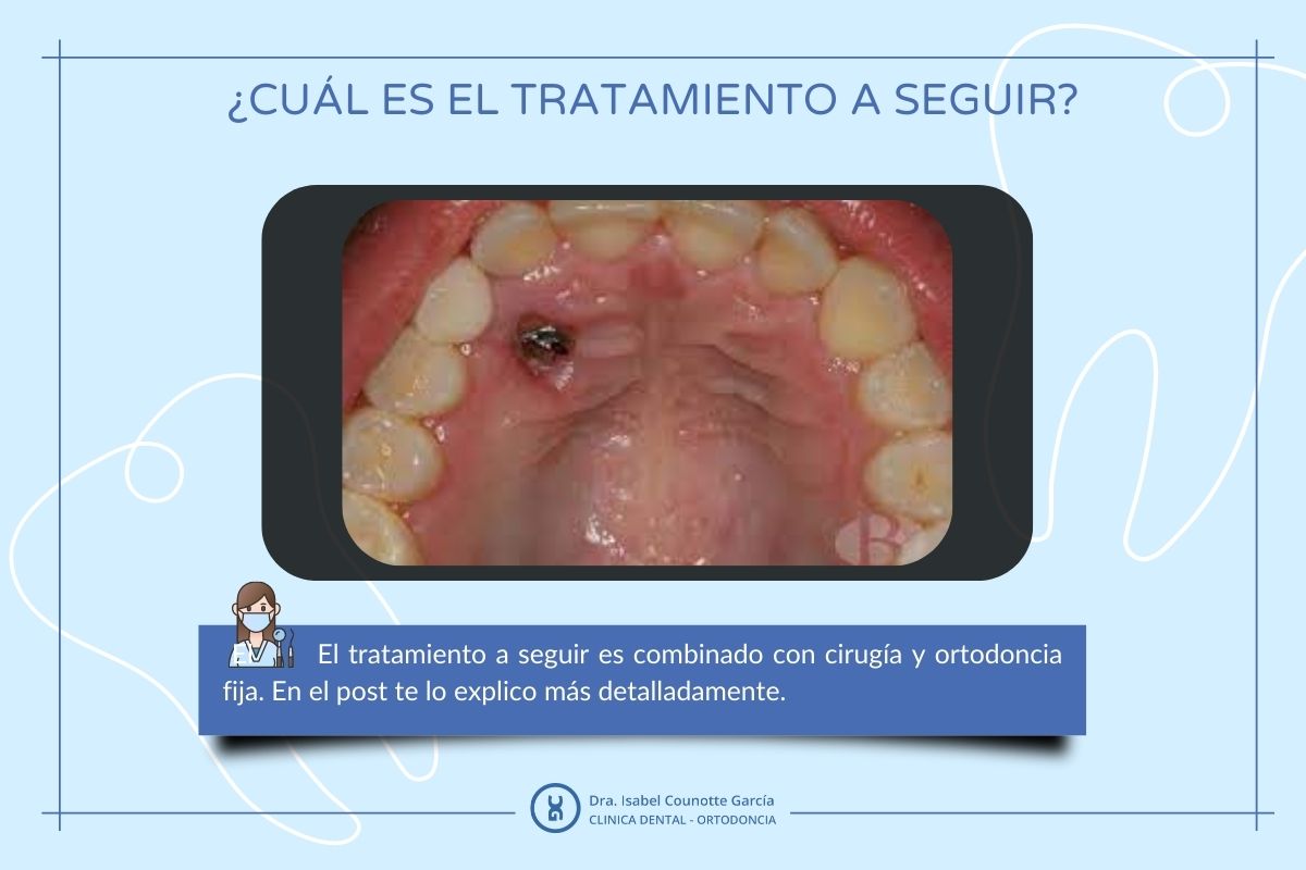 Tratamiento dental con cirugía y ortodoncia.