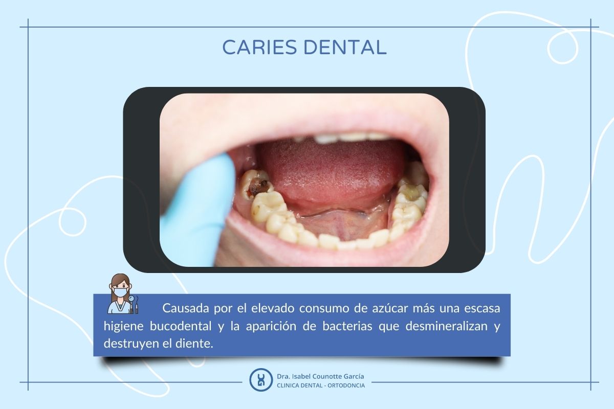 que es la odontopediatria caries dental